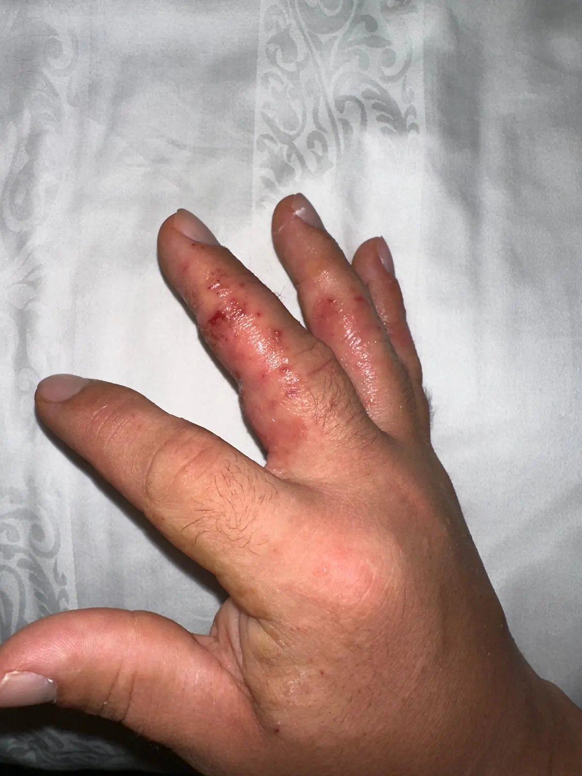 Kappel Hand